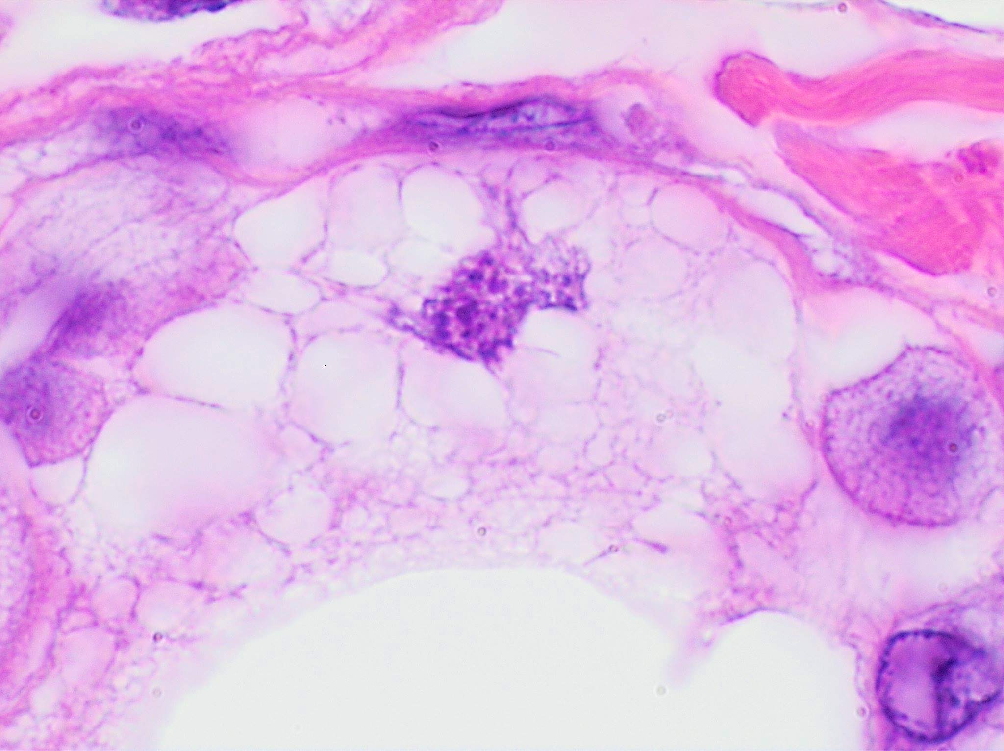 Lipoblast-like histiocyte in fat necrosis of the breast (H&E). A foamy histiocyte with lightly eosinophilic cytoplasm and a small normochromatic nucleus that is not hollowed out by lipid vacuoles, distinguishing it from a true lipoblast. Olympus LC30, by Mikael Haggstrom, M.D.