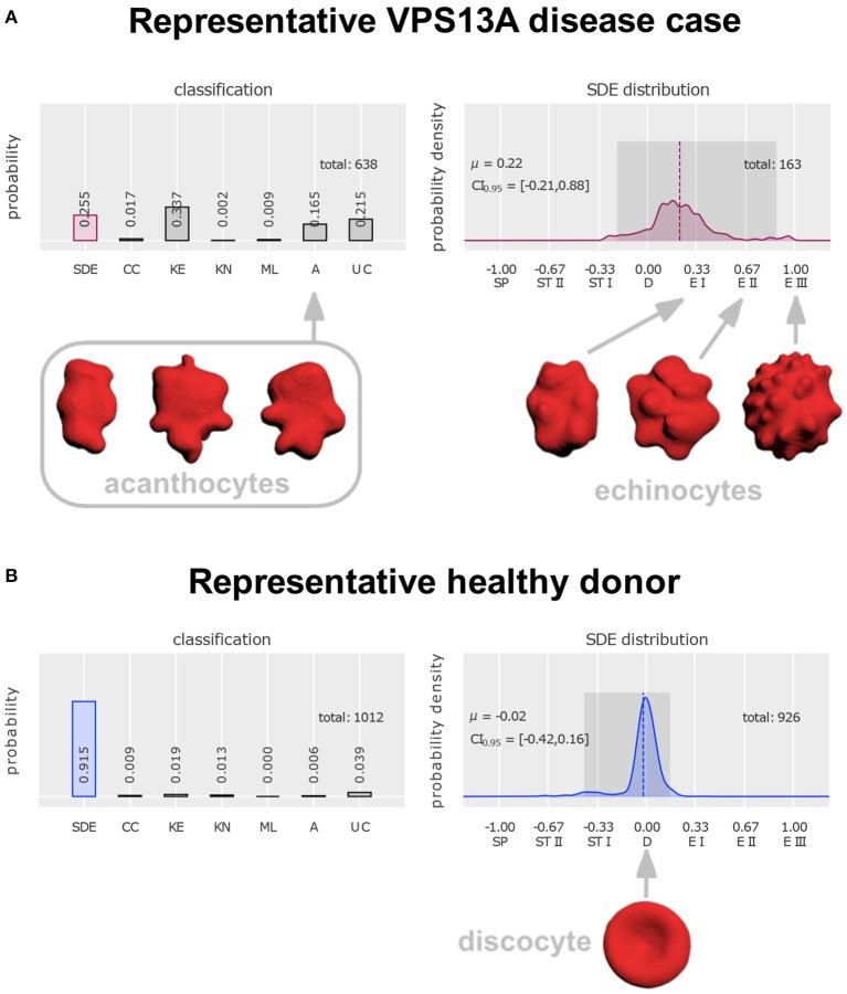Three-dimensional confocal microscopy images distinguishing acanthocytes from echinocytes, with artificial neural network classification. Acanthocytes (left panels) are erythrocytes with irregularly spaced, spicule-like projections of varying length that do not retract with dilution, as seen in neuroacanthocytosis and hypobetalipoproteinaemia. Echinocytes (right panels) have regularly spaced, shorter crenations that retract under physiological conditions. Confocal microscopy enables 3D resolution of surface projections. (human; Figure 1.)