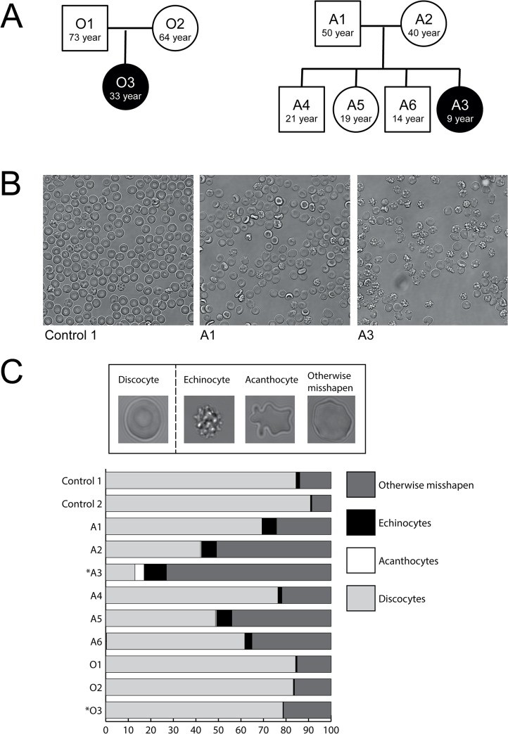 Peripheral blood smear showing acanthocytes in patients with PKAN (pantothenate kinase-associated neurodegeneration) and McLeod syndrome. Representative light micrographs comparing red blood cell morphology: acanthocytes (spiculated cells) from neuroacanthocytosis patients vs normal discocytes from controls. (human (peripheral blood, PKAN/McLeod neuroacanthocytosis); Figure 1, B.)