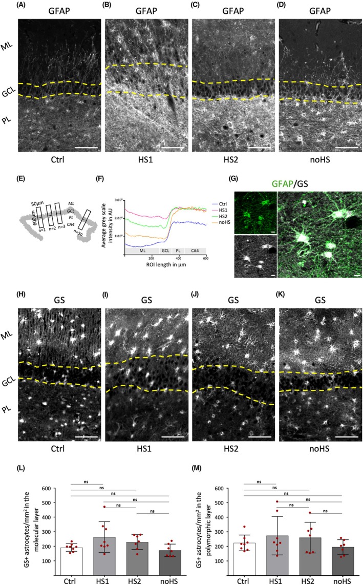 Subtype-specific increase of GFAP expression in the DG of MTLE patients occurs independently of changes in total astrocyte numbers. (A-D) Representative GFAP immunofluorescent images from (A) Ctrl, (B) HS1, (C) HS2, and (D) noHS cases reveal altered morphology and intensity of marker expression across the DG layers and among the patient cohorts. (E) Quantification of GFAP signal intensity using standardized rectangular regions of interest (ROIs) spanning from the ML to the PL (600 x 50 um). (human (postmortem dentate gyrus, control and MTLE patients); FIGURE 2.)