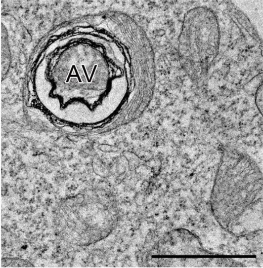 An autophagic vacuole (AV) by transmission electron microscopy in a Phoenix cell, one panel of a figure of TEM images of autophagic vacuoles in control Phoenix cells and mutated Δ2-4VPS13B clones. Primary and secondary lysosomes (autophagosomes, containing membrane structures of mitochondria and ER fragments at various stages of digestion) were found in the cytoplasm of control and mutant cells. Scale bar: 1 µm. (human (Phoenix cells); Figure 8.)