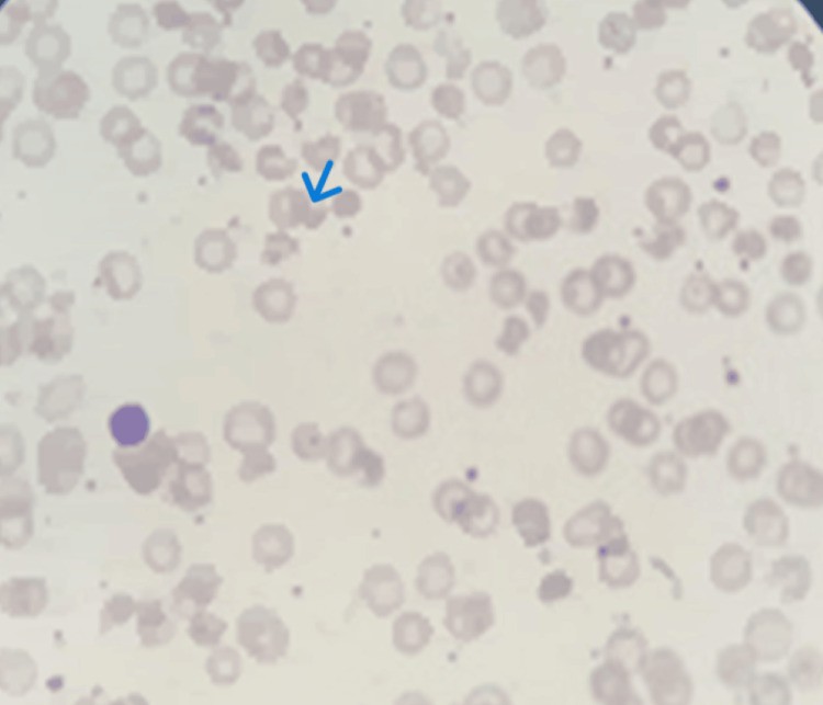 Blood film of case 2: Peripheral smear shows bitten RBCs (bite cells / blister cells) alongside echinocytes, polychromatic cells, and schistocytes. (human (neonatal peripheral blood, infantile pyknocytosis); Figure 5.)