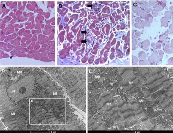 Histopathological findings from endomyocardial biopsy of a heart transplant recipient (control). Sections stained with Masson's trichrome (A, D) revealed normal myocardial architecture without fibrosis, vacuolization, or inflammation, and normal density of mitochondria. A few patients exhibited inflammatory infiltrates (arrows) (B) and some small areas with vacuolization (C, D). Despite the presence of the latter, transmission electron micrographs do not reveal any glycogen deposits (E, F). TEM panels (D, E) show mitochondria (Mt), myofibrils (Mf), and sarcomere structure in normal human cardiomyocytes. (human (endomyocardial biopsy, heart transplant recipient control); Figure 2, full figure (control endomyocardial biopsy).)