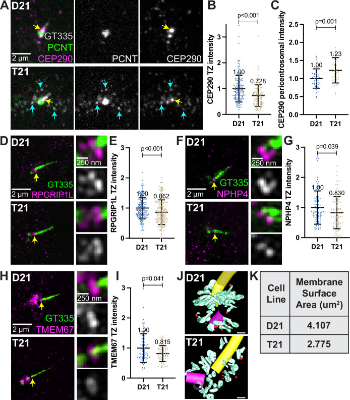 Decreased transition zone protein localization in ciliated trisomy 21 cells. ( A ) Representative confocal images of RPE1 D21 and T21 cells grown on coverslips and serum depleted for 24 hr. Cells were stained with GT335, PCNT, and the transition zone protein CEP290. Yellow arrows point to the CEP290 transition zone population and cyan arrows point to CEP290 satellites that colocalize with PCNT. (
