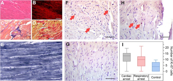 Histological study of stained slides: Ischemic myocardium in rats. (A) Light microscopy with hematoxylin and eosin (H&E) staining, x200; (B) the same section, polarized light, intense anisotropic areas are visible in some cardiomyocytes, x200; (C) Mallory's trichrome staining, x200; (D) Lie staining (HBFP), some areas of early ischemia are visible, x200; (E) Weigert's iron hematoxylin staining, the striation of cardiac muscle tissue is visible, x800; (F-H) groups with cardiac arrest, sham intervention, and respiratory arrest, respectively. Ob. x40. Red arrows mark the Ki67+ cells. Scalebar 40 um; (I) the number of Ki67+ cells. (rat (ischemic myocardium, cardiac arrest, sham, and respiratory arrest groups); Figure 3.)