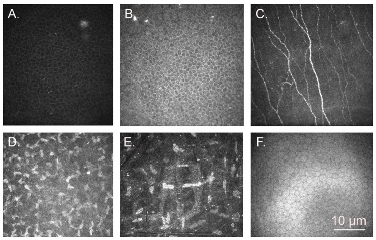 Confocal microscopy of the cornea of a 38-year-old human female showing all major layers. (A) Superficial epithelium with flat, polygonal cells. (B) Basal epithelium with columnar cells. (C) Sub-basal nerve plexus in Bowman's layer. (D) Anterior stroma with keratocytes. (E) Posterior stroma. (F) Endothelium showing the characteristic hexagonal mosaic pattern. Scale bar applies to all panels. (Homo sapiens; Figure 5.)