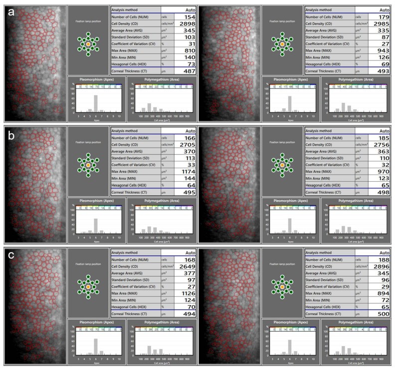 Specular microscopy of human corneal endothelium showing endothelial cell density (ECD) measurements before and after phakic intraocular lens (pIOL) implantation. The characteristic hexagonal mosaic of corneal endothelial cells is visible. Scale bar and cell count annotation shown in the automated analysis overlay. (Homo sapiens; Figure 1.)
