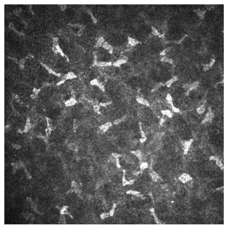 In vivo confocal microscopy of the corneal stroma showing activated keratocytes with abnormal hyperreflectivity in a patient with Sjogren's syndrome. Keratocytes appear as stellate cells with bright cell bodies and processes within the stromal lamellae. (human (corneal stroma, Sjogren's syndrome context); Figure 1.)