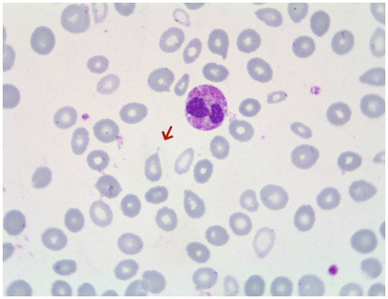 Peripheral blood smear of a patient with primary myelofibrosis presenting with portal hypertension. Arrows indicate teardrop-shaped red blood cells (dacryocytes), characteristic of myelofibrotic marrow replacement. (human (peripheral blood, primary myelofibrosis); Figure 3.)