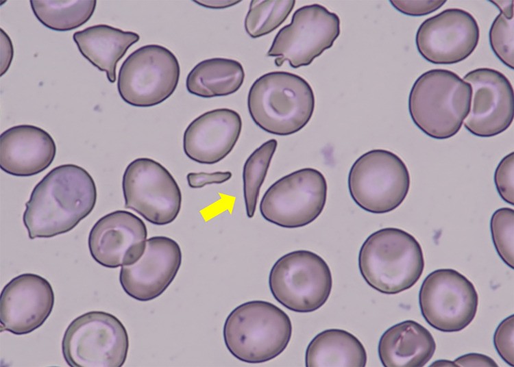 Peripheral blood smear (x1000 magnification) showing sickle cells constituting 4% of all erythrocytes in a patient with hemoglobin sickle-beta-thalassemia (HbSbeta+). Drepanocytes (sickle-shaped RBCs), hypochromic microcytes (beta-thalassemia component), and target cells visible. (human (peripheral blood, hemoglobin sickle-beta-thalassemia); Figure 3.)