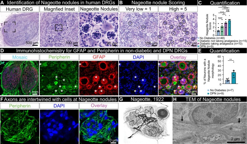 Haematoxylin and eosin staining of human dorsal root ganglia (DRG) from organ donors, showing sensory neuron cell bodies (large, round pseudounipolar neurons with prominent nucleolus) and surrounding satellite glial cells. DRGs from a study of 90 organ donors. (human (organ donors); Figure 1, A.)