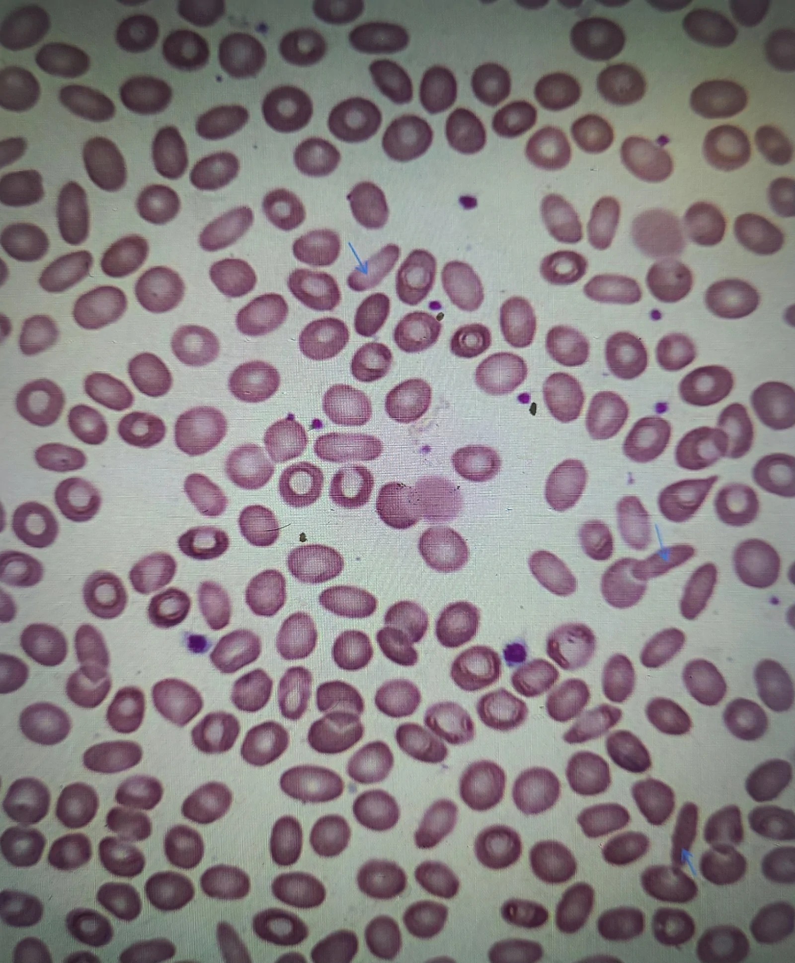 Peripheral blood smear showing elliptocytes (thin blue arrow) in a patient with hereditary elliptocytosis identified during evaluation of splenomegaly. Wright-Giemsa stain, 100x magnification. (human (peripheral blood, hereditary elliptocytosis); Figure 2.)