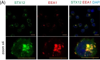 STX12 depletion disrupts early endocytic trafficking in GSCs. Confocal immunofluorescence showing colocalization of STX12 (green) with the early endosome marker EEA1 (red) in GSCs. Nuclear staining with DAPI is shown in blue. Corresponding higher-magnification insets are shown below. Scale bars: 10 um.