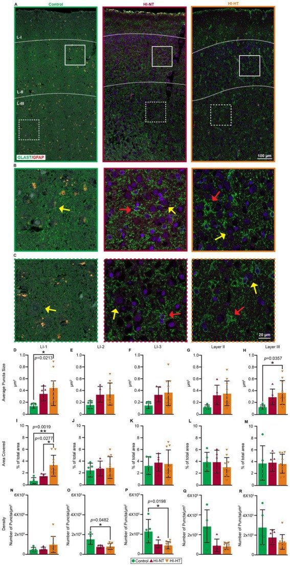 Localization of GLAST and GFAP in human neonatal cortex. (A–C) Representative immunofluorescence images from human neonatal cortex from control, HI-NT (normothermia), and HI-HT (hypothermia) cases. Low magnification images show GFAP-positive astrocytes (red) and GLAST-positive astrocytes (green) distributed in layers of the cortex. GFAP is the canonical astrocyte marker; GLAST is a glutamate transporter enriched in astrocytes. Scale bar 200 μm. (Homo sapiens; Figure 2.)