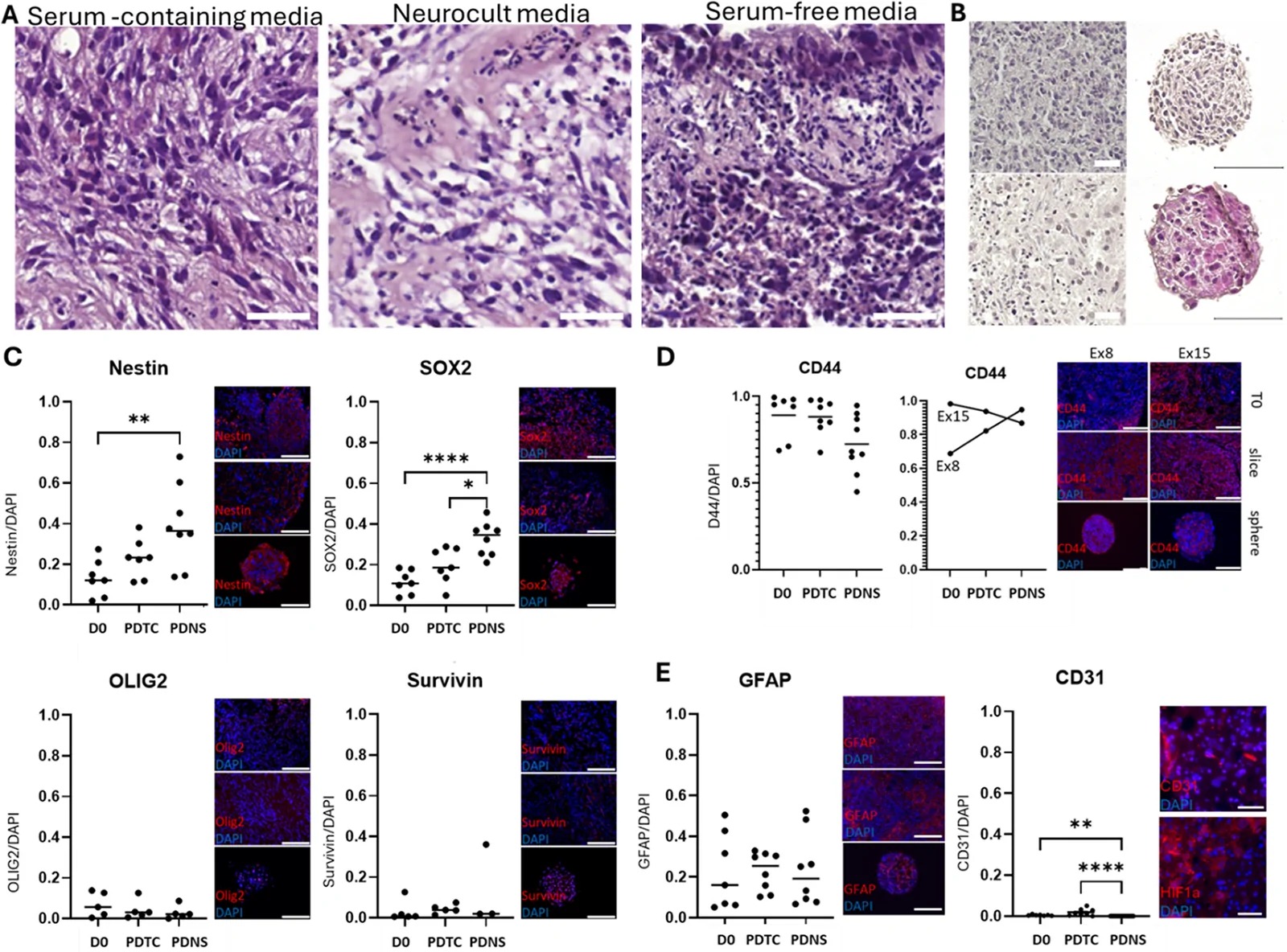 Histological characterization of PDTC and PDNS. (A) Representative hematoxylin and eosin (H&E) staining of GBM PDTCs cultured under different media conditions to evaluate preservation of tissue morphology and architecture (scale bar = 50 um). Organotypic hippocampal slice culture medium and serum-free NeuroCult medium maintained tissue integrity most effectively, whereas other serum-free media resulted in progressive loss of structural organization. (B) Representative images illustrating morphological differences between PDTCs and matched PDNS generated from two independent patient specimens (upper and lower rows, respectively, NeuroCult media). PDTCs preserved native tissue architecture and cellular heterogeneity, whereas PDNS formed compact multicellular spheroids with reduced structural complexity (scale bar = 100 um). (C) Quantification of stem cell markers in native tumor tissue, PDTCs, and PDNS (n = 4 patients, NeuroCult media). Expression of stem cell-associated markers (Survivin, Olig2, SOX2, Nestin, and CD44) was compared between native tissue, PDTCs, and PDNS. (D) CD44 expression differed significantly between native tissue and PDNS, although substantial inter-patient heterogeneity was observed. (E) GFAP expression was preserved across culture conditions, whereas CD31-positive endothelial cells were largely absent in PDNS. Representative immunohistochemical staining for HIF1alpha is shown in PDTC. Statistical analysis was performed using the Kruskal-Wallis test followed by Dunn's multiple-comparison test (*p < 0.05, **p < 0.01, ****p < 0.0001). (Fig. 2.)