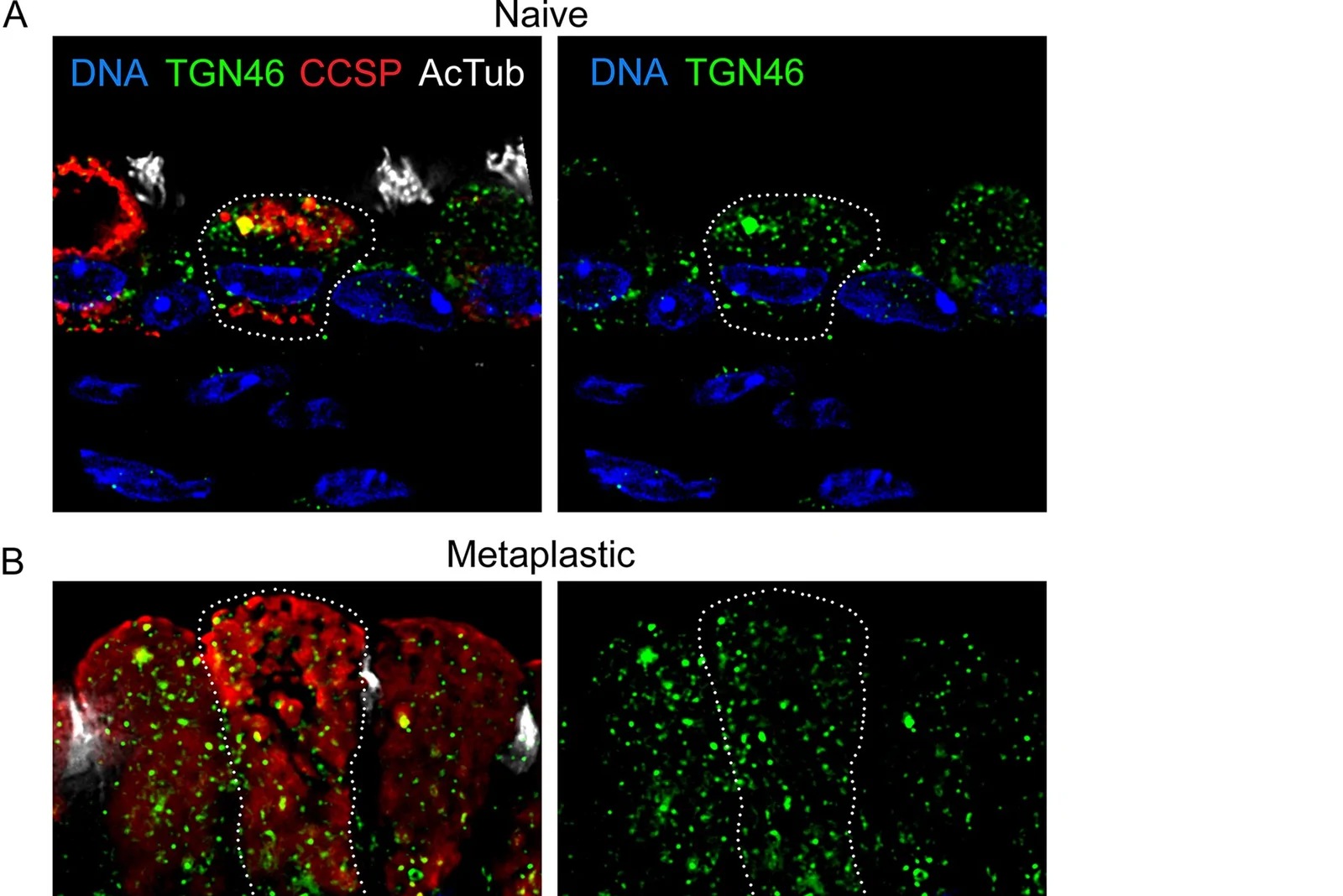 Numerous widely distributed trans-Golgi network (TGN) elements in mouse airway secretory cells. (A) Immunofluorescence deconvolution microscopy using antibodies against club cell secretory protein (CCSP) to mark secretory cells, acetylated tubulin (AcTub) to mark ciliated cells, TGN46 to mark the trans-Golgi network, and DAPI to stain nuclei in the axial bronchi of mice not exposed (naive) to cytokines. (B) Microscopy as in (A), but in mice with mucous metaplasia due to intrapharyngeal treatment with 1 ug IL-13.