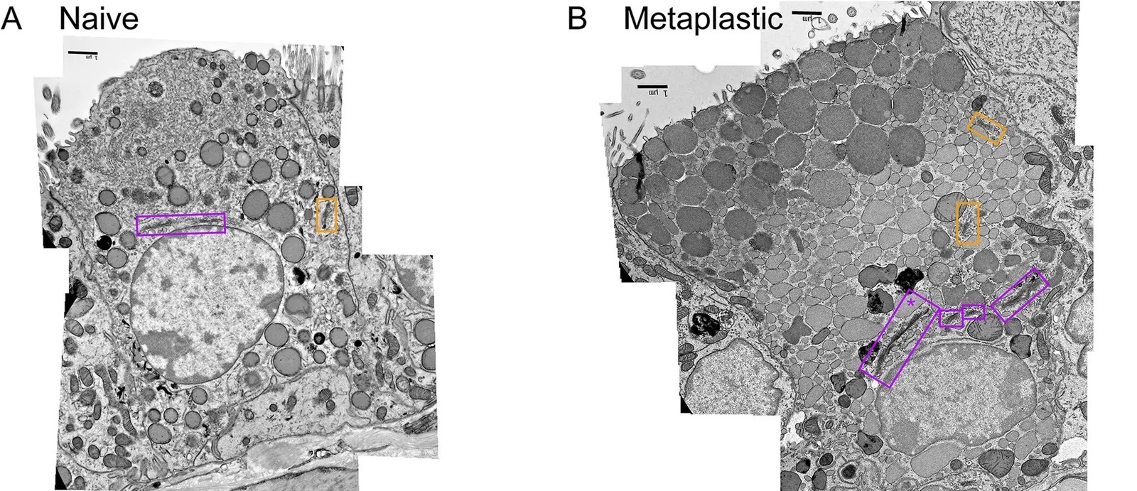 Electron microscopic analysis of Golgi structure in mouse airway secretory cells. Cellular profiles were compiled from multiple electron micrographs of secretory cells in mouse axial bronchi to include apical, basal, and lateral plasma membranes as well as a portion of the nucleus. (A) Representative airway secretory cell of a naive mouse. The Golgi ribbon is outlined in purple, a Golgi satellite is outlined in orange, and both are also shown at higher magnification. All scale bars in (A) and (B) are 1 um. (B) Representative metaplastic secretory cell in the airway of a mouse treated with 0.2 ug IL-13. The Golgi ribbon and satellites are outlined as in (A).