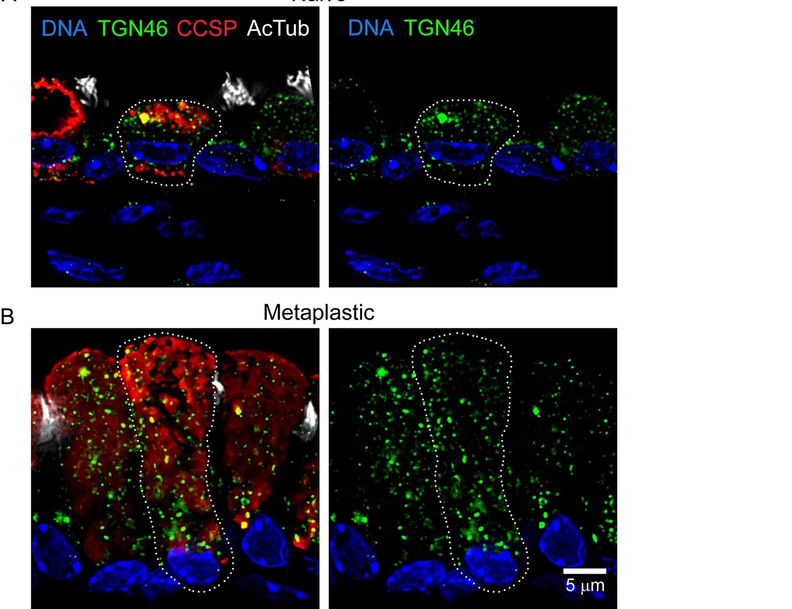 Numerous widely distributed trans-Golgi network (TGN) elements in mouse airway secretory cells. (A) Immunofluorescence deconvolution microscopy using antibodies against club cell secretory protein (CCSP) to mark secretory cells, acetylated tubulin (AcTub) to mark ciliated cells, TGN46 to mark the trans-Golgi network, and DAPI to stain nuclei in the axial bronchi of mice not exposed (naive) to cytokines. The scale bar in (B) also applies here. (B) Microscopy as in (A), but in mice with mucous metaplasia due to intrapharyngeal treatment with 1 ug IL-13. Adapted: IF panels A and B only; quantification panel C and fibroblast panel D excluded. (mouse (airway secretory cells); Figure 1, panels A and B (IF deconvolution microscopy only; quantification panel C and fibroblast panel D excluded; rows 30-1260 of full figure, 1600x1230).)