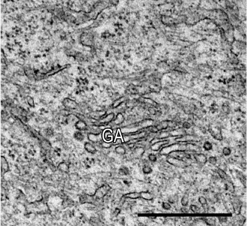 Morphological changes of GA in Phoenix delta2-4VPS13B clones by TEM analysis. Electron micrographs of the Golgi apparatus in the cytoplasm of control Phoenix cells and mutant Phoenix cells (A) demonstrates dictyosome stacks that are ordered and continuous in control cells and short, fragmented, and swollen in mutant delta2-4VPS13B cells. Scale bar: 1 um. (human (Phoenix cells, control condition); Figure 3A (control).)