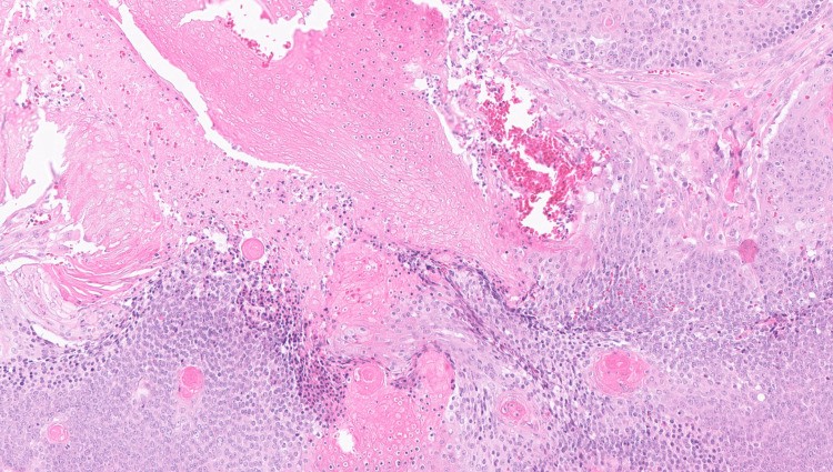 Histological section (H&E, ×200) of a pilomatrixoma (pilomatricoma) of the eyelid showing characteristic basaloid cells and ghost (shadow) cells. Basaloid cells are proliferating hair matrix-like cells arranged in lobules; ghost cells are their enucleated, cornified remnants. Pilomatrixoma is a benign tumor of hair follicle matrix cell origin. (human (eyelid, pilomatrixoma excision); Figure 3.)