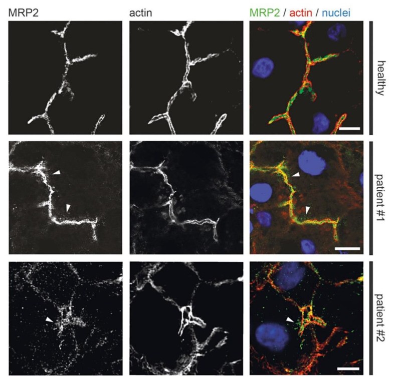 Localization of MRP2 in MYO5B-PFIC hepatocytes compared to healthy controls. Immunofluorescence showing normal apical MRP2 localization at bile canaliculi in healthy control human hepatocytes. Actin staining outlines the bile canaliculus with its microvilli. (Homo sapiens; Figure 7.)