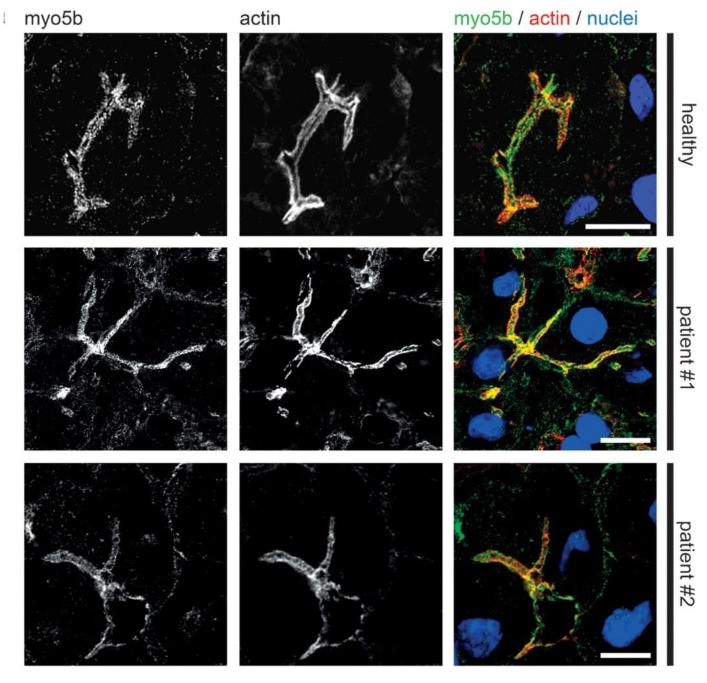 Localization of Myo5b in MYO5B-PFIC hepatocytes compared to healthy controls. Laser-scanning immunofluorescence micrographs showing regular bile canaliculus morphology in healthy control human hepatocytes, with myo5b at the apical plasma membrane and actin outlining the bile canaliculus with its microvilli. (Homo sapiens; Figure 5.)