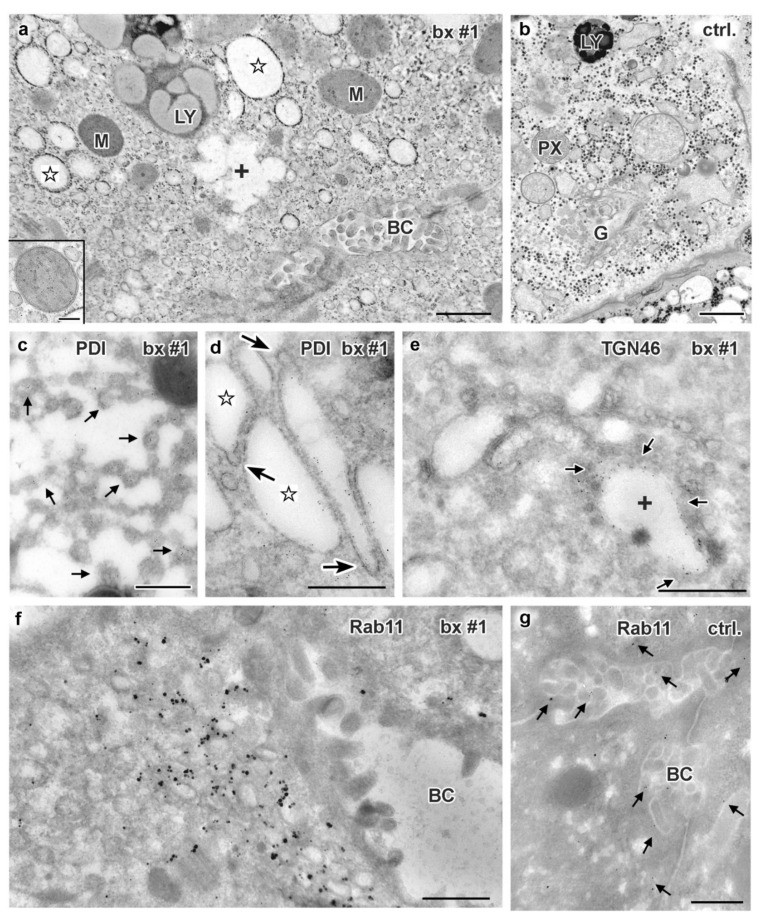 Ultrastructure and immuno-gold electron microscopy of aldehyde-fixed human liver biopsies. Control hepatocyte (panel b) shows normal bile canaliculus with microvilli, tight junctions, and surrounding hepatocyte membranes. MYO5B-PFIC patient sample (panel a) is shown for comparison alongside control canalicular ultrastructure. (Homo sapiens; Figure 9.)