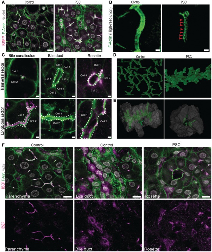 Hepatocytes of PSC patients accumulate apical bulkheads in bile canaliculi. Human liver tissue immunofluorescence showing ZO-1 (tight junction marker outlining bile canaliculi) and F-Actin co-staining. PSC patient hepatocytes show apical bulkheads compared to normal canalicular network. Scale bars indicated. (Homo sapiens; Figure 4.)