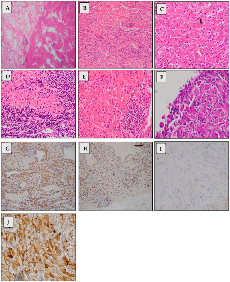 (A) Low-power view of interface between normal lung and nodule of CSH. (B) Low-power view of histiocytes with abundant eosinophilic cytoplasm containing crystals within alveolar space. (C) High-power view of histiocytes with eosinophilic cytoplasm containing elongated, parallel, fine eosinophilic structures consistent with needle-like crystalloid material. Yellow arrow points to one of the crystals. (D,E) High-power view of histiocytes with eosinophilic cytoplasm containing needle-like crystalloid materials with surrounding lymphocytes and plasma cells. (F,I,J) PAS, CD138 and CD68 stain, respectively. (G,H) Immunohistochemistry for lambda light chain and kappa light chain, respectively. Dual staining pattern. Objective magnifications: (A,B) x4; (C-E) x40; and (F-J) x10. (Figure 4.)