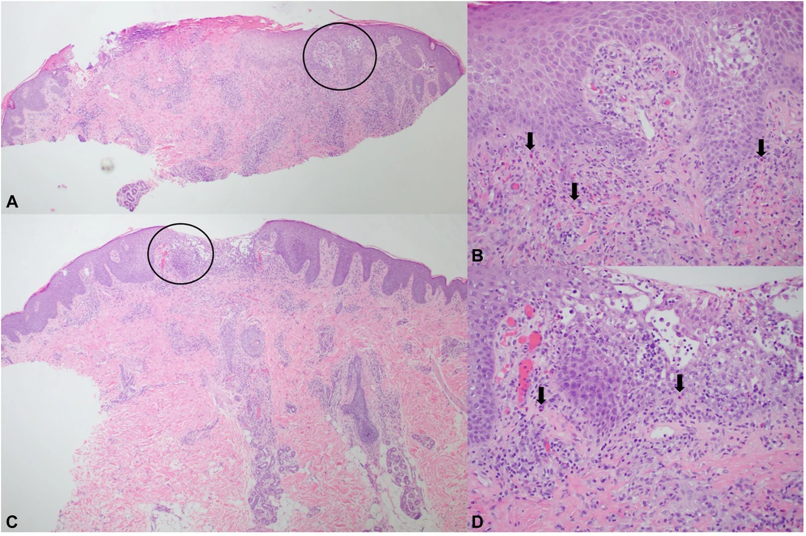 Case 1: Histology. The biopsy of the back lesion (A) (4x, H&E) on low-power shows a partially eroded epidermis with areas of spongiosis and overlying parakeratosis and serum crust. Within the dermis, perivascular inflammation is seen, extending into the mid dermis. B, (20x, H&E) Higher-power highlights epidermal spongiosis and brisk inflammation containing increased numbers of eosinophils. The biopsy of the arm lesion (C) (4x, H&E) shows a discrete area of spongiosis and perivascular inflammation. D, (20x, H&E) Higher power shows prominent epidermal spongiosis with lymphocytic exocytosis and scattered intraepidermal eosinophils. Black arrows demonstrate infiltration with eosinophils both within the epidermis and throughout the dermis. (Fig 2.)