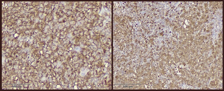Immunohistochemistry staining of congenital Langerhans cell histiocytosis: (a) strong positive membranous immunostaining for CD1a (x40 magnification; scale bar = 100 um); (b) strong positive nuclear and cytoplasmic immunostaining for S100 (x40 magnification; scale bar = 200 um). (Figure 3.)