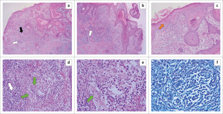 Tuberculoid leprosy: (a, b) Haematoxylin and eosin (H&E) stain showing superficial and deep dermal infiltration with non-caseating granulomas (black arrow) surrounded by numerous lymphocytes (white arrows) (a, x2; b, x4). (c) H&E; epidermal involvement with lymphocytic exocytosis (orange arrow) and absence of a grenz zone (x10). (d, e) H&E; perivascular granulomatous inflammation with abundant lymphocytes and Langhans-type giant cells (green arrows) (d, x20; e, x40). (f) Fite-Faraco stain: no acid-fast bacilli identified (x40). (FIGURE 3.)