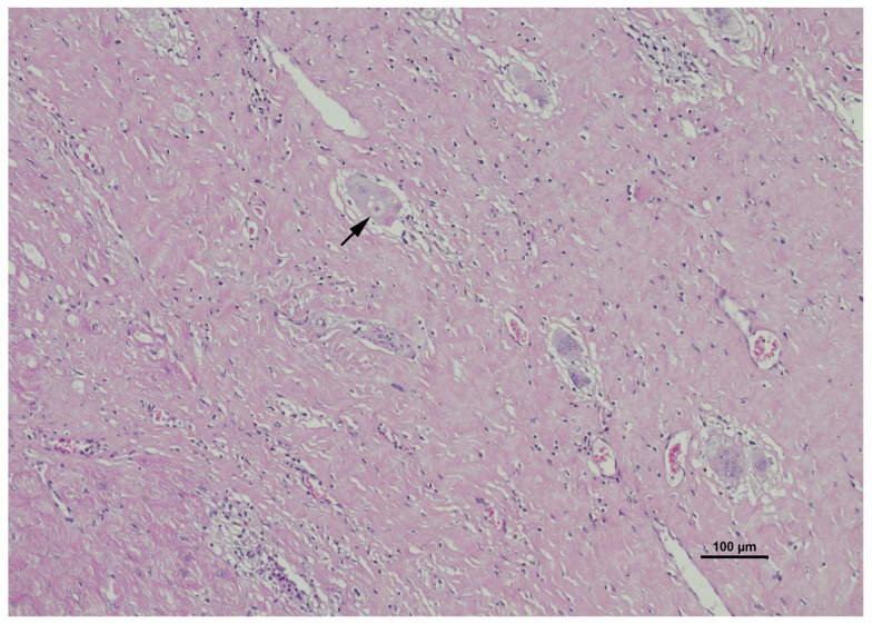 Hematoxylin and Eosin (H&E) staining of myocardial tissue demonstrating a characteristic asteroid body. The black arrow highlights a distinct, star-shaped intracytoplasmic inclusion known as an asteroid body or stellate inclusion housed within a large multinucleated giant cell. These eosinophilic structures are frequently observed within granulomatous infiltrates on standard light microscopy. (human (myocardial tissue biopsy from a patient with cardiac sarcoidosis); Figure 5.)