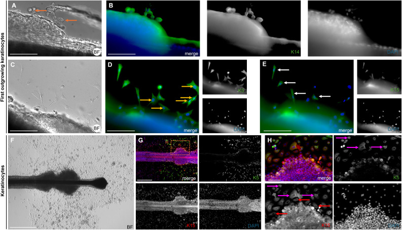 Keratin expression in first outgrowing and adherent keratinocytes. Brightfield image (A) of the bubble-like keratinocytes in the area of the ORS, with an IF image (B) of the same region stained for K14 (green). Brightfield image (C) showing the first outgrowing keratinocytes in the ORS area, with corresponding IF images for K5 (D) and K15 (E). Cells positive only for K5 are marked with orange arrows, and double- positive K5 and K15 cells are marked with white arrows Brightfield image (F) of a HF at a later culture stage, showing thickening of the ORS in distal and proximal regions, with proliferating keratinocytes visible near the follicle. Immunofluorescence staining for K5 and K15 in the same HF region (G). In the magnified section (H), magenta arrows mark K5/K15 double-positive keratinocytes, red arrows indicate cells positive for K15 only. Scale bar: 500 um (F, G), 250 um (A-E), 100 um (H). (human (plucked hair follicle, outgrowing and adherent keratinocytes); Figure 7.)
