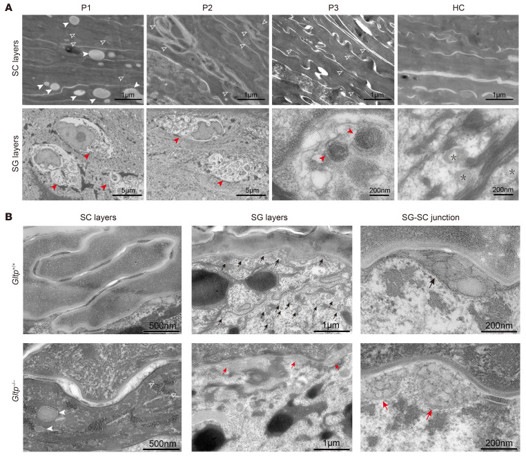 Ultrastructural changes in the epidermis of GLTP-nEDD patients and the Gltp-deficient mice. ( A ) Transmission electron microscopy (TEM) analysis of epidermal ultrastructure in patient (P) skin biopsies and a healthy control (HC). Representative images reveal distinct pathological features in patient corneocytes, including numerous vacuoles (solid white arrowheads) and curved membrane structures (hollow white arrowheads). Keratinocytes within the stratum granulosum exhibit irregular perinuclear accumulations of abnormal membranous and vesicular material (red arrowheads), accompanied by reduced lamellar body counts and disrupted lamellar organization. In contrast, healthy human epidermis demonstrates homogeneous, electron-dense, amorphous keratin substance in the stratum corneum and abundant normally structured lamellar bodies (black asterisks) in the granular layer. ( B ) TEM of murine epidermis indicates intact intercellular lipid lamellae in corneocytes layers of Gltp +/+ epidermis but absent in the Gltp -/- epidermis. Gltp -/- epidermis displayed numerous vacuoles in corneocytes (solid white arrowheads), curved membrane structures (hollow white arrowheads). In the stratum granulosum, lamellar bodies (red arrows) were reduced in number and display disrupted organization in Gltp -/- mice, contrasting with abundant well-structured lamellar bodies in Gltp +/+ epidermis (black arrows). SC, stratum corneum; SG, stratum granulosum. (Figure 4.)
