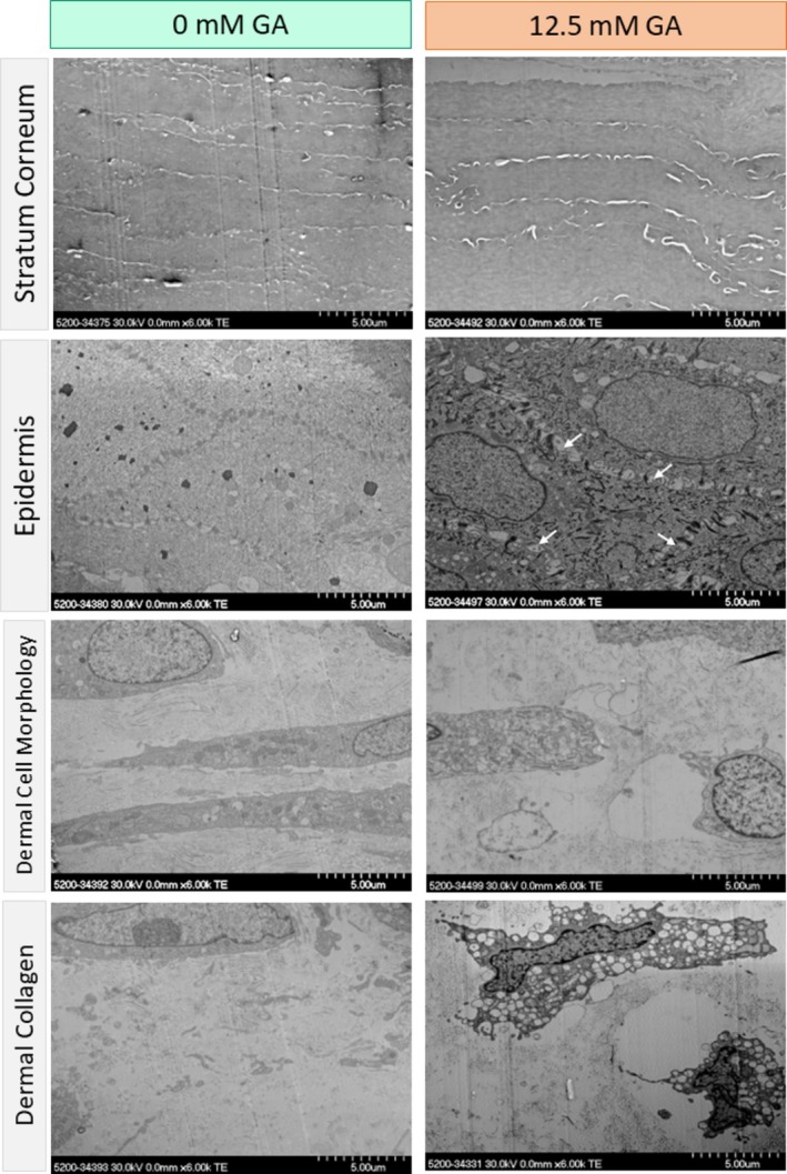 Scanning transmission electron microscopy (STEM) of control and in vitro treated model skin. Representative images of stratum corneum, epidermis, dermal cell, and dermal collagen of control and 12.5 glycated in vitro skin models. No morphological differences were observed in the stratum corneum. Cell-cell junctions in the epidermis exhibited increased gapping upon GA treatment (white arrows). Changes in cell shape and collagen fiber distribution were observed after GA treatment in the dermal layer. (human (in vitro engineered skin model from human keratinocytes and fibroblasts; glyceraldehyde treatment to mimic glycation); Figure 3.)