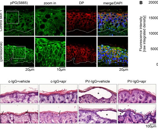(A) Immunostaining of pPG(S665) and DP in control skin 1 (pemphigus-negative). White dotted lines represent basement membrane of epidermis. DP costaining was used as desmosome marker. Scale bars: 10 µm; 20 µm. (human (control epidermis, pemphigus-negative); Figure 1, panel A, control arm (pemphigus-negative human skin; cols 22-567 of figure).)