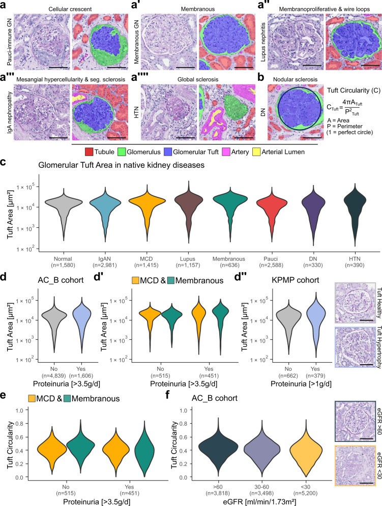 Segmentation visualisations of glomeruli in major glomerular injury patterns from PAS-stained human kidney biopsies. Representative images from the internal AC_B cohort showing glomeruli with varying injury patterns. The glomerular architecture shows capillary tuft, mesangial matrix, podocytes, and Bowman's capsule. Automated glomerular instance segmentation overlay shown in color. (Homo sapiens; Figure 1.)
