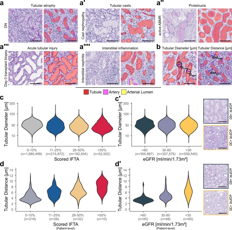 Segmentation visualisations of tubules with large variation in size and shape in various diseases and morphological injury patterns. PAS-stained human kidney biopsy patches from the internal AC_B cohort (1043 patient biopsies). Proximal and distal tubules are visible with their characteristic epithelial cell morphology, including the brush border of proximal tubule cells. Automated tubule instance segmentation overlay shown in color. (Homo sapiens; Figure 2.)