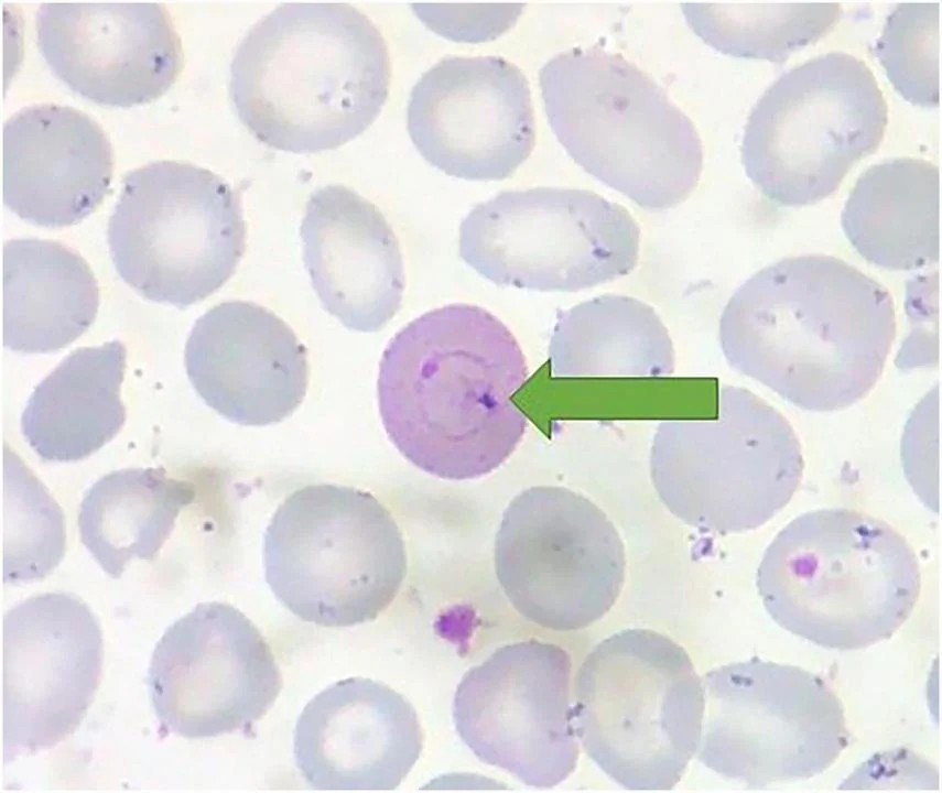Peripheral blood smear in vitamin B12 deficiency (megaloblastic anaemia). Panel (a): macro-ovalocytes (oval macrocytes, yellow arrow) — large oval erythrocytes characteristic of megaloblastic defects in nuclear maturation — alongside a hypersegmented neutrophil (black arrow, five or more lobes) and a nucleated red blood cell/normoblast (green arrow). Panel (b): a red blood cell containing a Howell-Jolly body (red arrow), a nuclear remnant seen in megaloblastic anaemia. Wright-Giemsa stain. (human (vitamin B12 deficiency, megaloblastic anaemia); Figure 3, a-b.)
