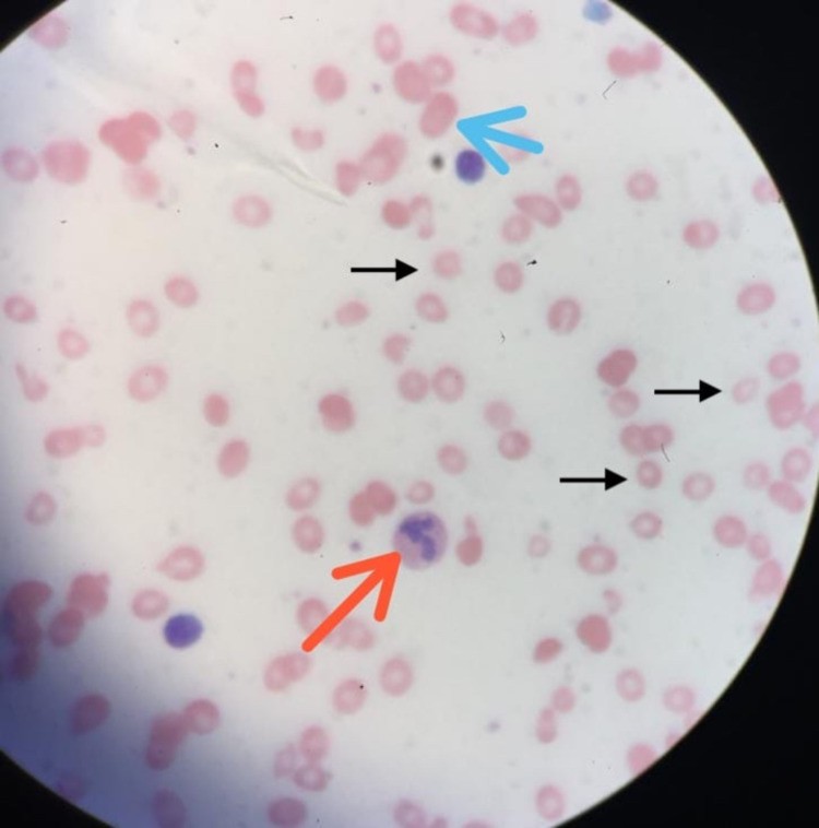 Peripheral blood film (microscopic view) showing a mixed picture of microcytosis (black arrow), macro-ovalocyte (blue arrow), and hypersegmented neutrophils (red arrows) in a patient with concurrent iron deficiency and vitamin B12 deficiency anemia. (human (peripheral blood, combined B12 and iron deficiency); Figure 3.)