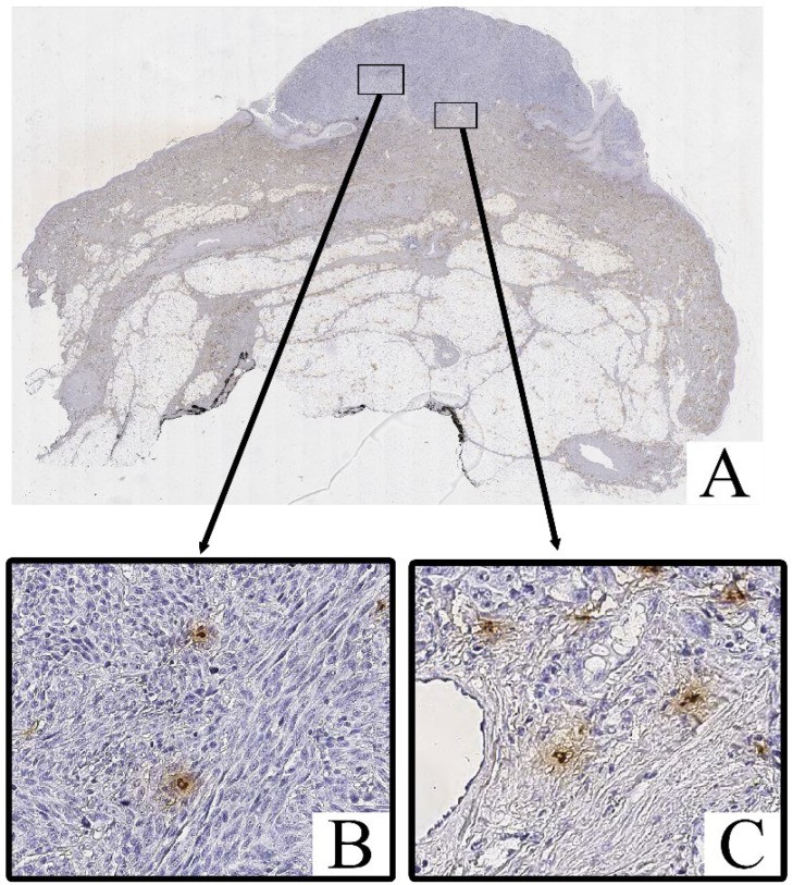 Human mast cells identified by immunohistochemical reaction with anti-Tryptase antibodies in invasive melanoma tissue (nodular subtype, pT4b). Magnification ×400. Tryptase is a serine protease stored in secretory granules and is the most specific marker for mast cells. (A) histoscan; (B) intratumoral mast cells; (C) peritumoral mast cells. (human (cutaneous melanoma tissue, intratumoral and peritumoral); Figure 3.)