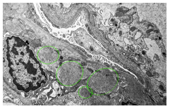 Electron microscopy of renal biopsy showing massive mesangial and subendothelial electron-dense deposits at magnification ×7000 in a patient with rapidly progressive IgA nephropathy and systemic lupus erythematosus. Mesangial cells and mesangial matrix are visible alongside the dense immune deposits. (human (kidney biopsy, IgA nephropathy/SLE); Figure 3.)