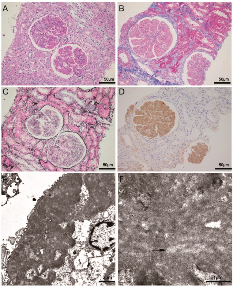 PAS stain of renal biopsy showing glomerular enlargement with mesangial expansion in a patient with FN1 fibronectin nephropathy. Diffuse PAS-positive staining with prominent mesangial matrix is evident. Mesangial cells are highlighted by the expanded mesangial compartment. (human (kidney biopsy, fibronectin nephropathy); Figure 1, A.)