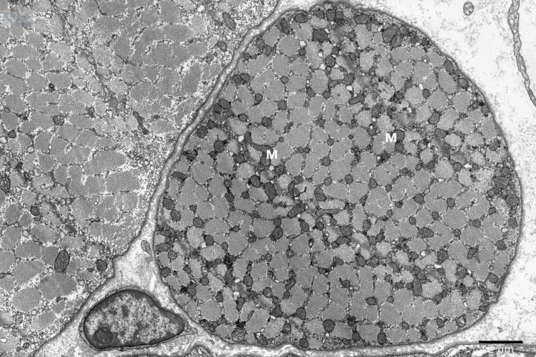 Regularly arranged intramyofibrillar mitochondria (M) in the ultrastructure of the normal striated muscle fiber, magnification x8000. (human (striated muscle, aging study); Figure 2single.)