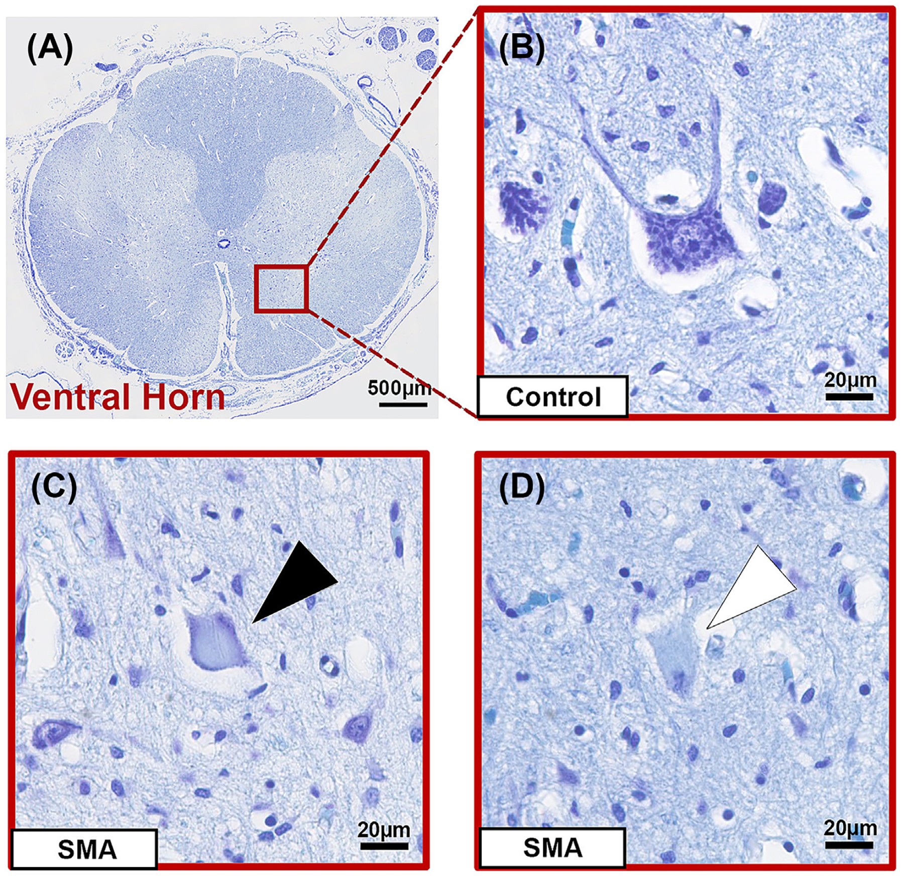 Nissl-stained section of human control thoracic spinal cord: (left) low-power showing the ventral horn location (boxed); (right) high-power micrograph of a healthy motor neuron with large multipolar cell body, centrally located nucleus and prominent nucleolus. Scale bars shown. (human (control infantile SMA study); Figure 3, A-B.)