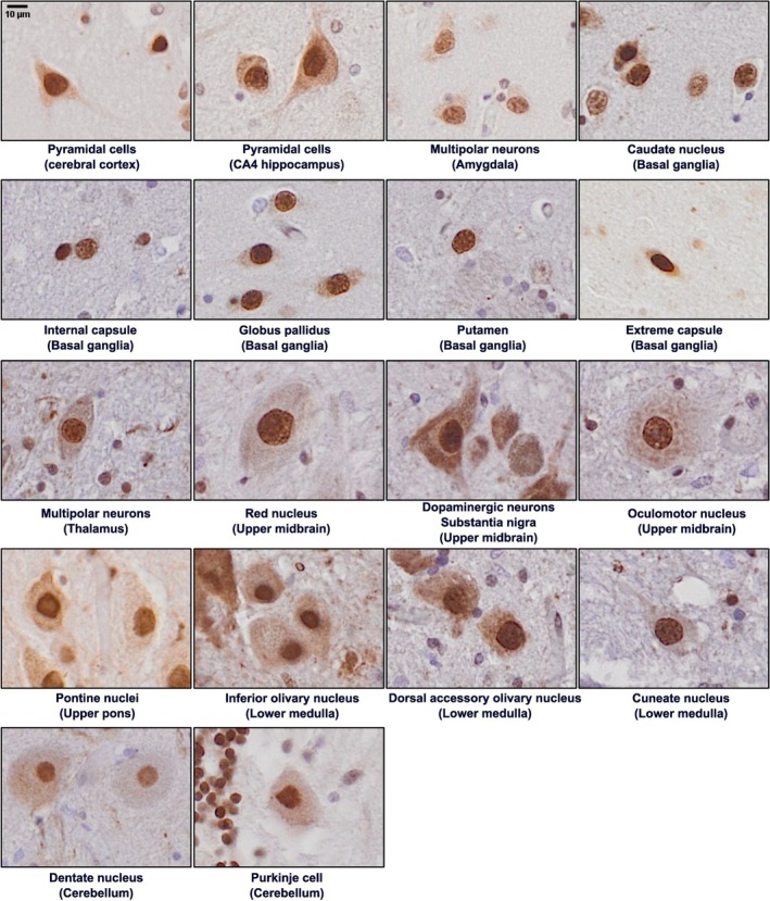 Normal hnRNP K staining and cell morphology in different neuronal populations. Pyramidal neurons exhibit the retention of hnRNP K in the nucleus across most brain regions. To illustrate normal hnRNP K staining patterns in pyramidal neurons, under normal physiological conditions, hnRNP K has a strong nuclear and minimal cytoplasmic presence within the neurons, which can be observed across all brain regions. The composite includes Purkinje cells (cerebellum), dentate nucleus, frontal cortex, temporal cortex, basal ganglia, thalamus, hypothalamus, midbrain nuclei, brainstem and spinal cord neurons. (human (post-mortem brain sections, various regions including cerebellum Purkinje cells); Figure 1, full figure.)