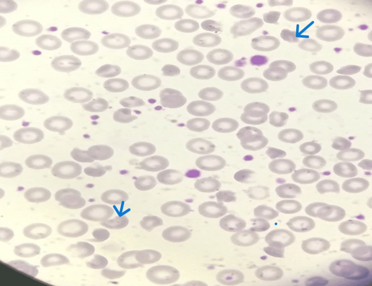 Peripheral blood smear from case 3 of infantile pyknocytosis. The smear shows normochromic normocytic RBCs with nucleated red blood cells (normoblasts, i.e., erythroblasts), polychromatic macrocytes, schistocytes, and irregularly contracted cells. Pyknocytes are indicated by blue arrows. Wright-Giemsa stain. (human (neonate, infantile pyknocytosis); Figure 6.)
