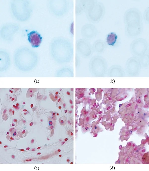 Peripheral blood smear showing nucleated erythroid precursors (normoblasts) with perinuclear iron granules, confirming ring sideroblast morphology. The nucleated red cell precursors are visible with a round-to-ovoid nucleus, basophilic cytoplasm, and characteristic iron granule deposits encircling the nucleus. The surrounding mature erythrocytes are smaller anucleate biconcave discs by comparison. (human (peripheral blood, ring sideroblastic anemia); Figure 2, a-b.)