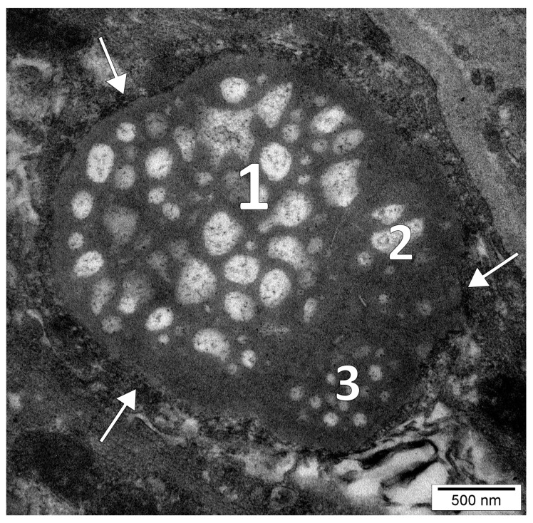 High magnification electron micrograph of the dental pulp of a human upper lateral incisor. A multilocular nucleolus is depicted consisting of three (1--3) aggregated bodies and coated by a layer of pre-ribosomes (white arrows). (human (dental pulp cell); Figure 2single.)